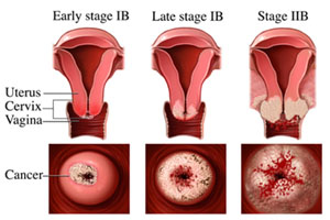Asian American Women and Cervical Cancer